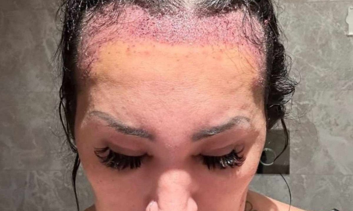 revela que há anos sofreu com os impactos emocionais que a perda de cabelo causou em sua autoestima -  (crédito: Arquivo Pessoal/ Divulgação)