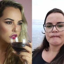 Influenciadora passa por três cirurgias para restaurar lábio após uso de PMMA - Reprodução/Instagram @mari_michelini