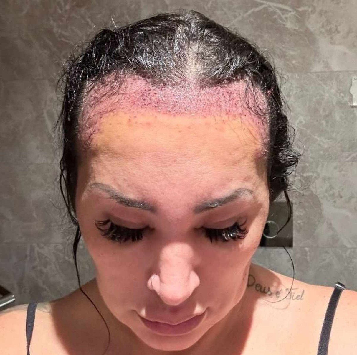 Calvície feminina: influenciadora conta experiência com transplante capilar