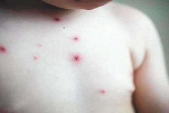 Herpes zoster em crianças: o que os pais devem saber?