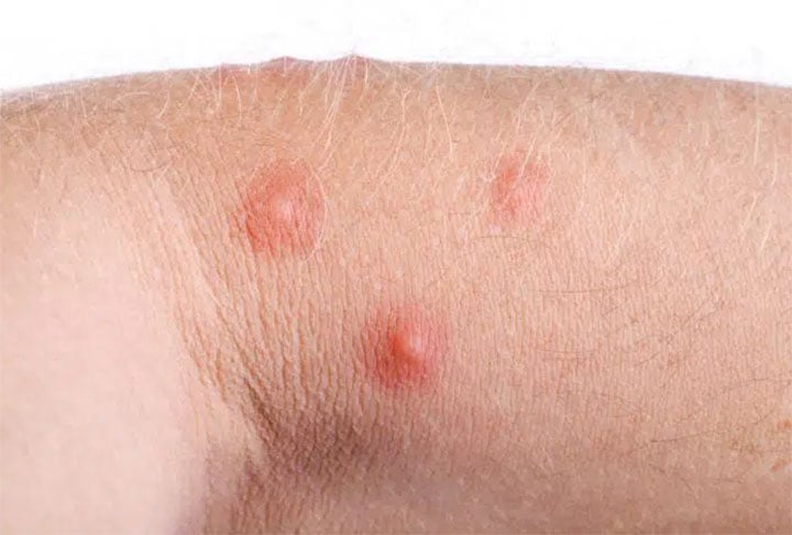 Após a picada da formiga, a pessoa têm queimação e coceira. Dependendo do número de picadas, se a pessoa for alérgica, os efeitos podem ser mais complexos, ocasionando coceira em todo o corpo, inchaço, necrose, dificuldade para respirar, coma e até mesmo morte