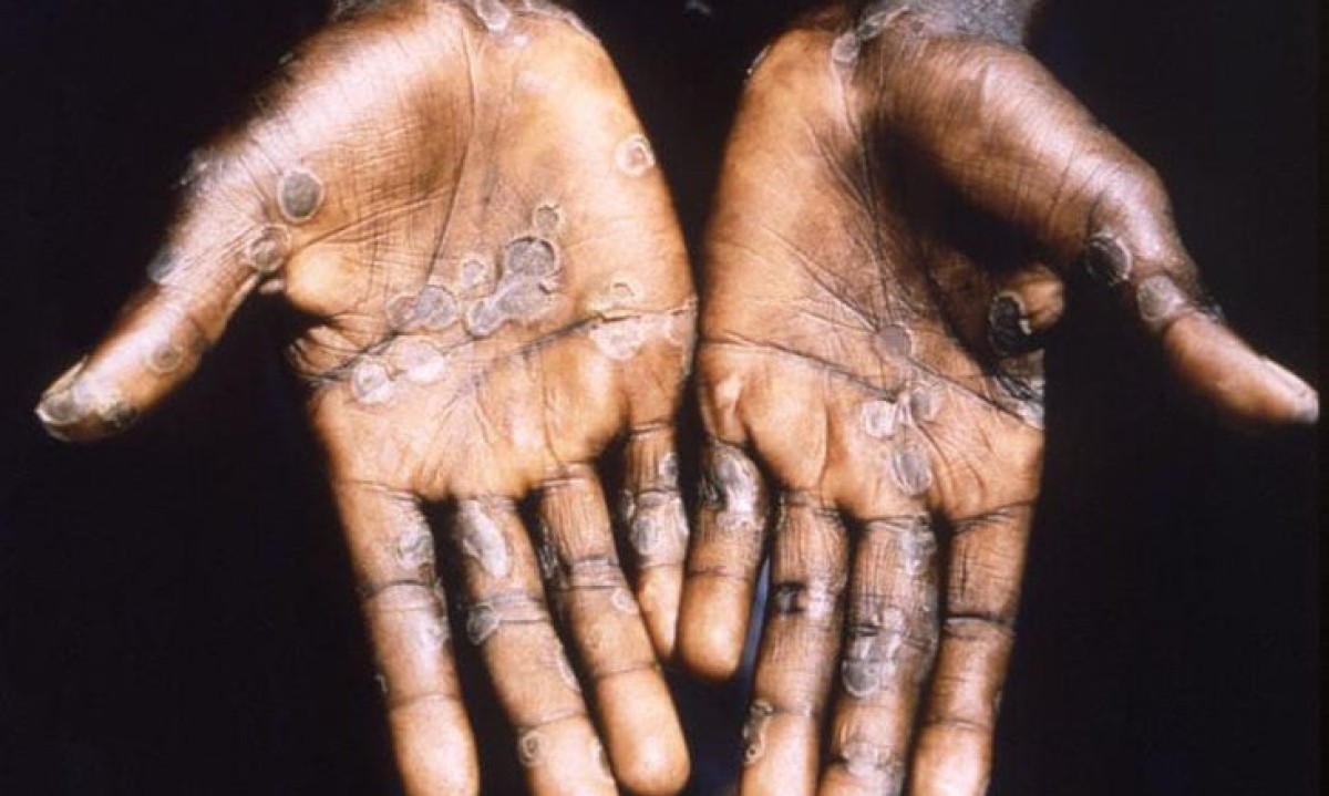Reino Unido cria lista de 24 doenças infecciosas que devem ser vigiadas - - phil / Centers for Disease Control and Prevention - CDC Dominio Publico
