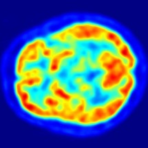 Estudo identifica marcadores para os 5 estágios clínicos do Parkinson - Jens Maus/Wikipedia