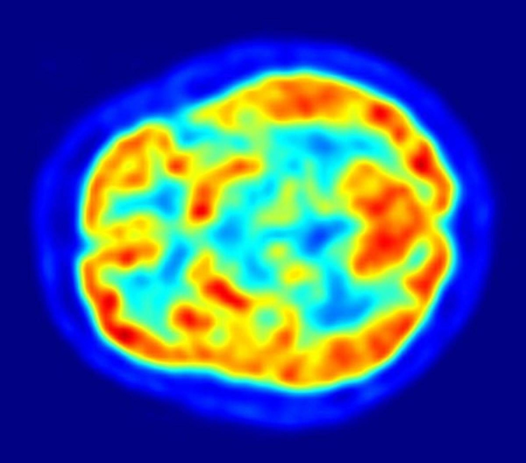 Estudo identifica marcadores para os 5 estágios clínicos do Parkinson