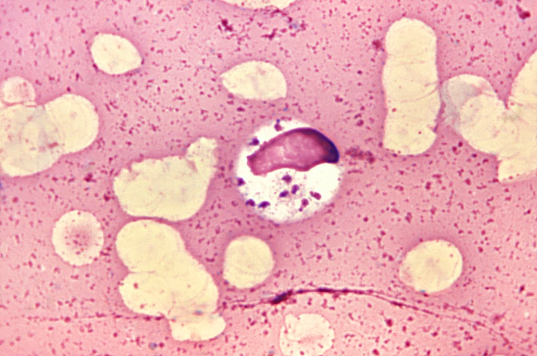 Leishmaniose - Causada pelo protozoário Leishmania, transmitido pelo mosquito-palha, com cães como reservatórios. Os sintomas incluem febre, fraqueza e feridas na pele