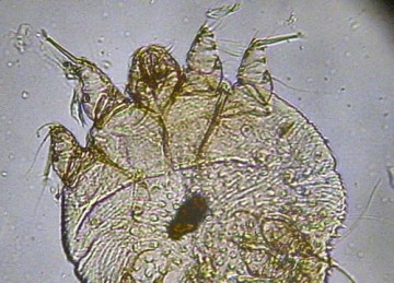 Sarna (escabiose) - Causada pelo ácaro Sarcoptes scabiei, a doença é transmitida pelo contato direto. Os sintomas incluem coceira intensa, vermelhidão e lesões na pele. - (crédito: kalumet wikimedia commons) Sarna (escabiose) - Causada pelo ácaro Sarcoptes scabiei, a doença é transmitida pelo contato direto. Os sintomas incluem coceira intensa, vermelhidão e lesões na pele. - (crédito: kalumet wikimedia commons)