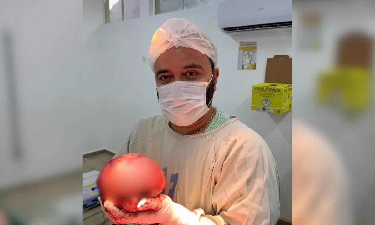 Médico exibe tumor gigante extraído de paciente em hospital no interior do RJ -  (crédito: Reprodução/Marino Oliveira)