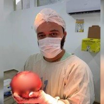 Médico mostra extração de tumor gigante de quase 2 kg - Reprodução/Marino Oliveira