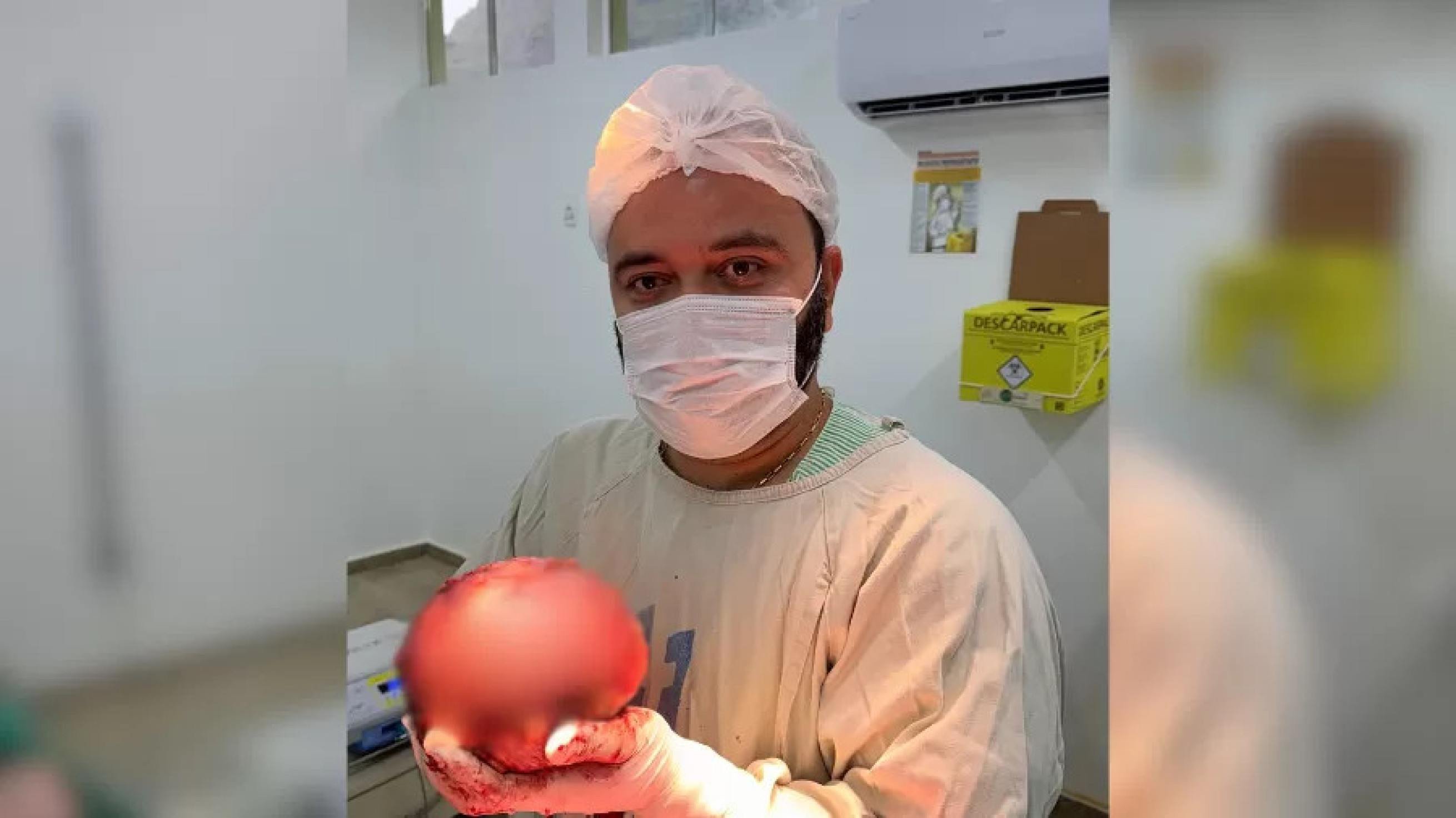Médico mostra extração de tumor gigante de quase 2 kg