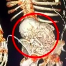 Mulher passa mais de 50 anos com feto calcificado na barriga - reprodução redes sociais