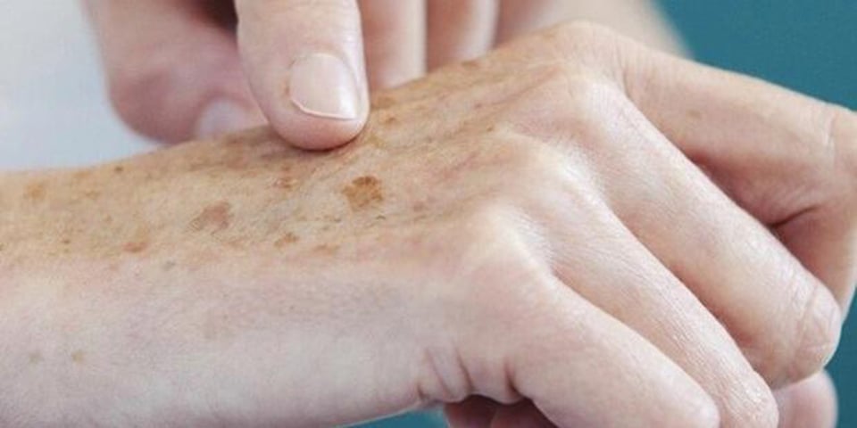 O melanoma (tipo mais grave de câncer)  aparece nos melanócitos, células responsáveis pela melanina, a pigmentação (cor) da pele. Desde que não haja metástase (quando o câncer se espalha para outras partes do corpo), a chance de cura beira os 95%. Já com metástase, as chances de cura rondam os 15%.  