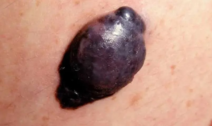  O melanoma nodular é considerado o tipo mais agressivo de melanoma e não tem uma região específica de incidência, podendo aparecer desde o couro cabeludo até os órgãos genitais. Ou seja, até mesmo partes do corpo não expostas ao sol. 