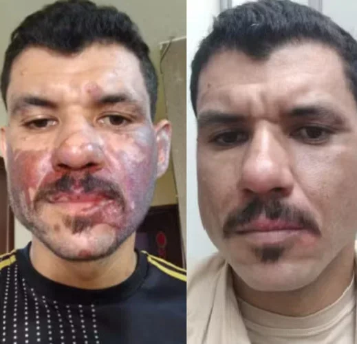 Após &#8216;explosão&#8217; de coxinha num bar, outro caso vem à tona: meses tratando a queimadura - Reprodução arquivo pessoal 