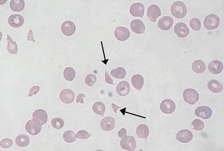 Caso a síndrome seja diagnosticada a tempo, o paciente consegue contornar as complicações com um tratamento à base de  anticorpos monoclonais específicos.