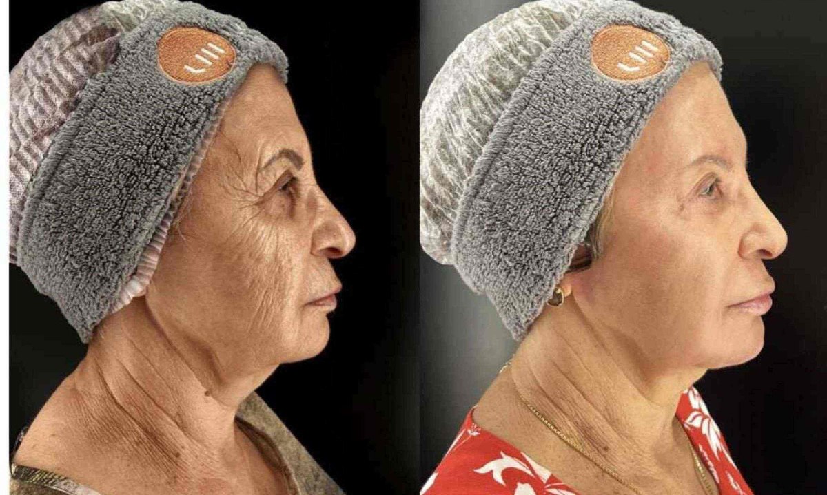 Antes e depois do tratamento de APhen Peel® em Maria Neusa -  (crédito: APhen Peel)