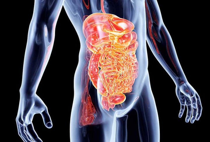 Na doença de Crohn, o sistema imunológico das pessoas responde de forma anormal a substâncias no intestino, causando inflamação e úlceras.