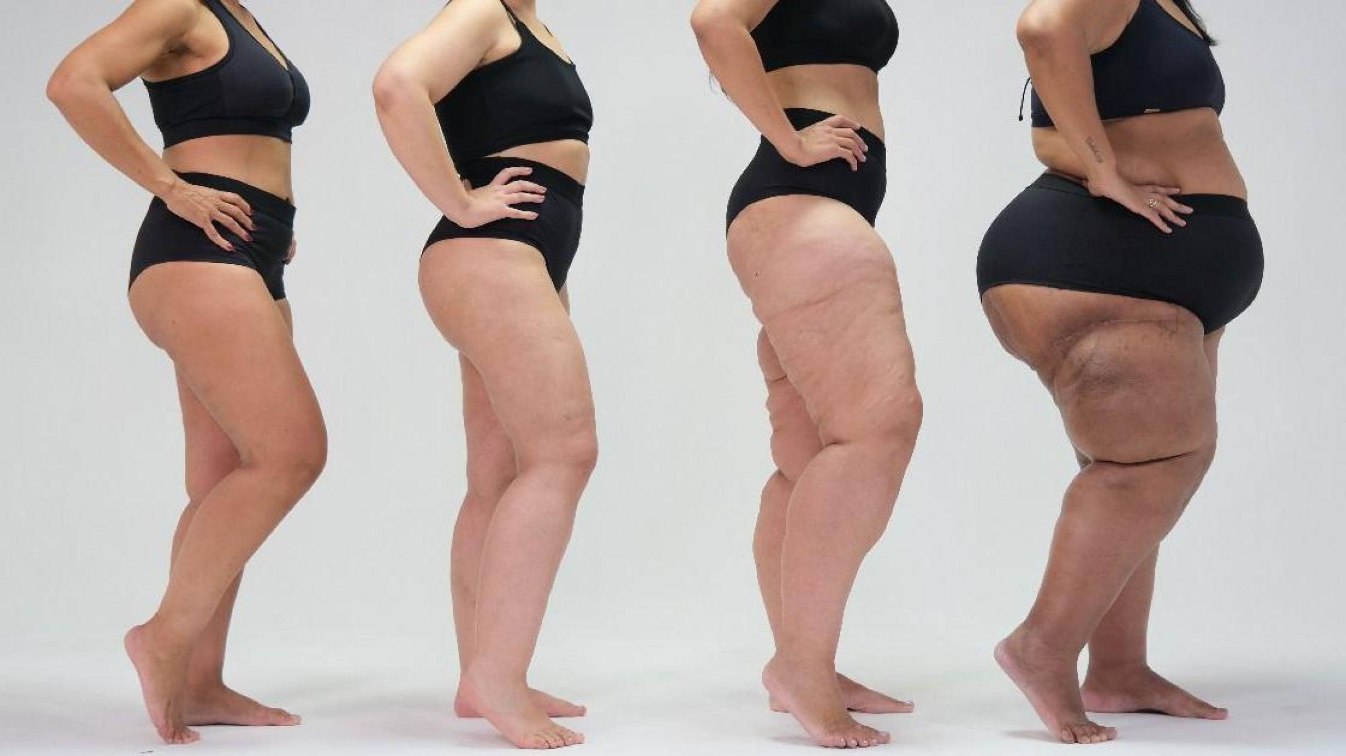 Lipedema: a 'nova' doença na lista da OMS que talvez você tenha sem saber