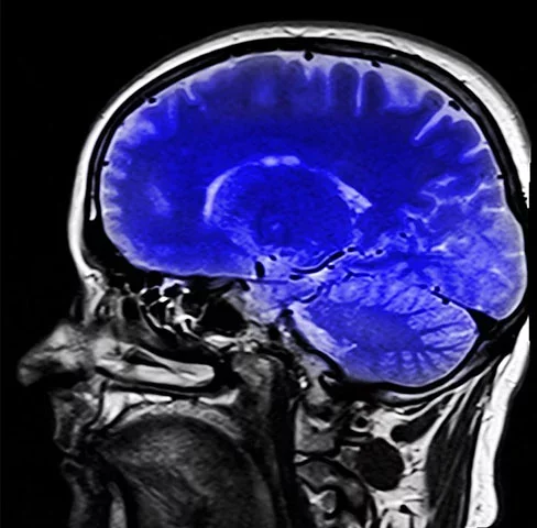 Os lobos frontais e temporais laterais são as áreas cerebrais mais afetadas.A DFT é uma condição mais rara que outros tipos de demência e a hereditariedade é um fator muito influente.