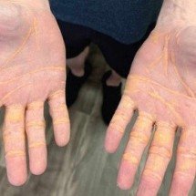 Xantelasma: homem acumula gordura e colesterol nas mãos; entenda - Jama Cardiology/Reprodução 