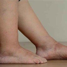 Linfedema: dieta e exercícios podem ajudar - Reprodução
