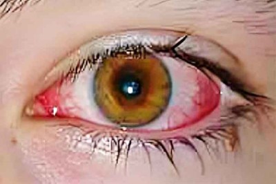 A conjuntivite é uma inflamação da membrana que reveste a parte anterior do olho e pode ser causada por infecções virais ou bacterianas, alergias ou substâncias químicas irritantes -  (crédito:  BrandonR/Wikimédia Commons)
