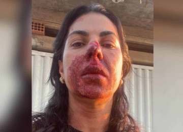 A oficial de Justiça Maria Sueli precisou ser hospitalizada após levar uma cabeçada e um soco no rosto

 -  (crédito: Imagens cedidas)