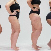 UFMG recebe evento científico sobre lipedema - ONG Movimento Lipedema/Conheça Lipedema