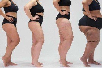 UFMG recebe evento científico sobre lipedema