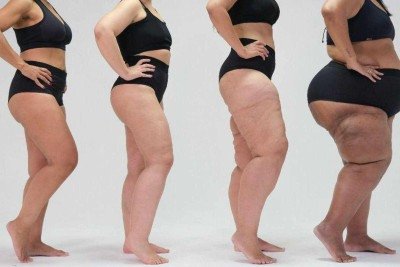Paciente mostra a diferença causada pelo lipedema no formato de seu corpo em foto de campanha de conscientização da doença feita pela ONG Movimento Lipedema -  (crédito: ONG Movimento Lipedema/Conheça Lipedema)