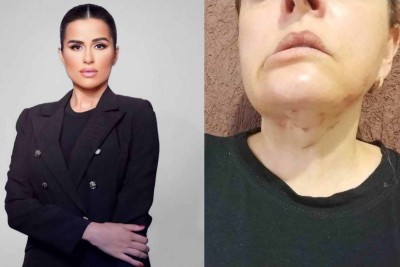 Dentista Camila Groppo segue atendendo enquanto pacientes ainda vivem com as cicatrizes da cirurgia e da infeccção -  (crédito: Reprodução/Redes sociais)
