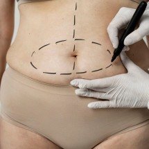Umbigo de abdominoplastia: como evitar? - FreePik