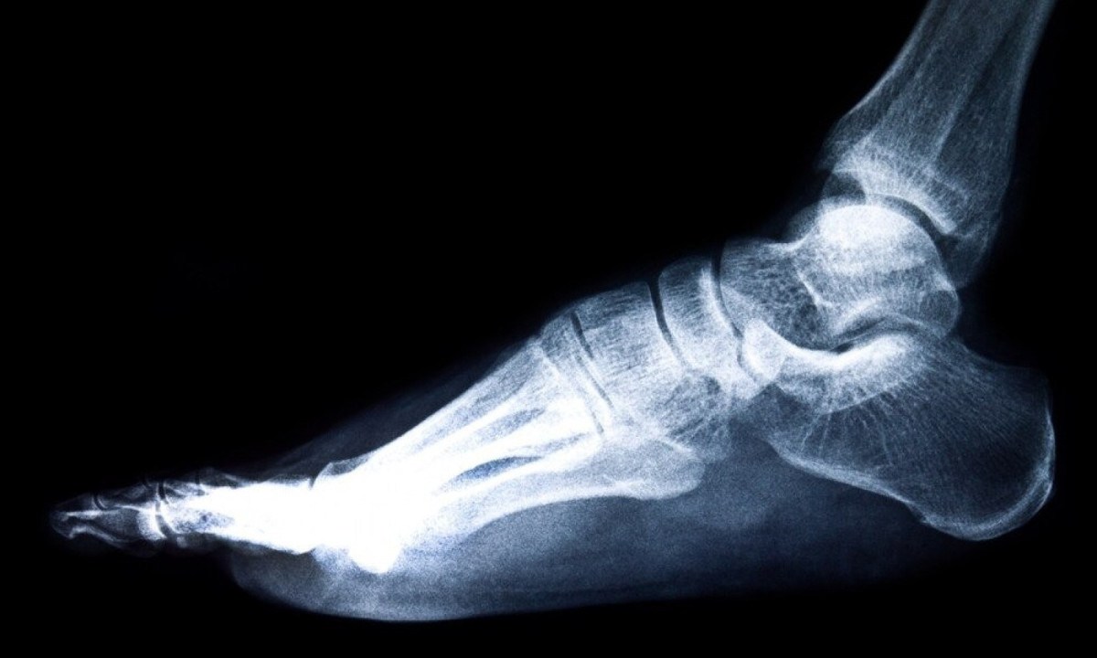 Apesar de aparecer nas radiografias, o esporão em si nem sempre é o vilão. Muitas vezes, a dor vem da fáscia plantar inflamada, da sobrecarga mecânica ou até de outras causas - (crédito: zirconicusso/freepik) Apesar de aparecer nas radiografias, o esporão em si nem sempre é o vilão. Muitas vezes, a dor vem da fáscia plantar inflamada, da sobrecarga mecânica ou até de outras causas - (crédito: zirconicusso/freepik)