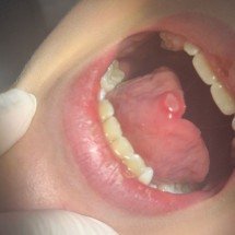 Reação ao creme dental em criança de BH reforça alerta da Anvisa - Acervo pessoal 