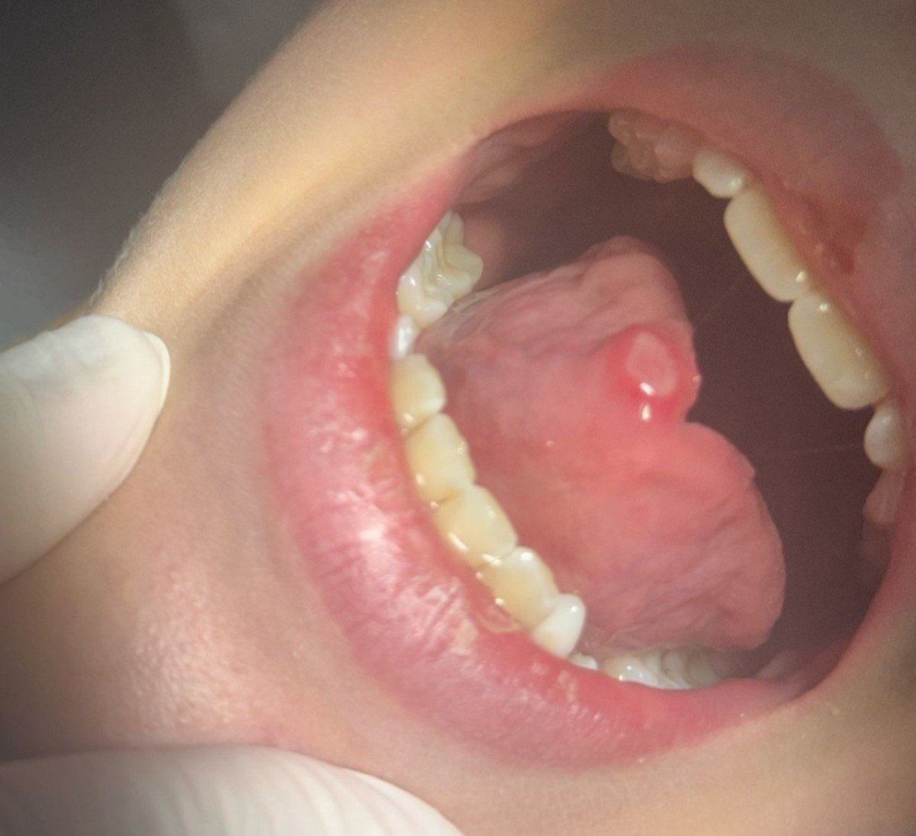 Francisco, de 11, foi uma das pessoas que teve reação ao utilizar o creme dental Colgate Total Clean Mint -  (crédito: Acervo pessoal )