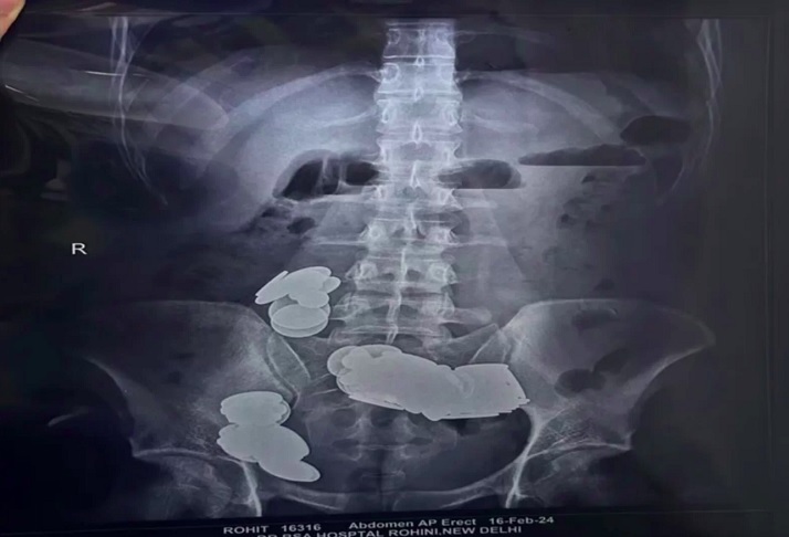 Os médicos viram que os ímãs e as moedas formaram dois grupos no intestino delgado por conta da força magnética, causando danos à parede intestinal.-Reprodução/Hospital Sir Ganga Ram