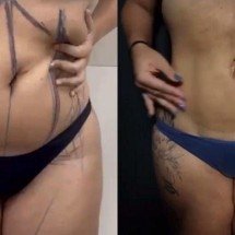 Cirurgia plástica: técnica brasileira promete abdominoplastia sem cicatriz - Leonardo Duque/Divulgação
