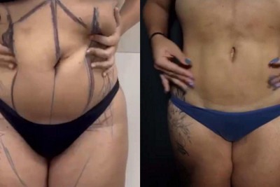 A técnica é indicada para pessoas com flacidez leve a moderada, que desejam melhorar o contorno abdominal, mas não querem ou não podem se submeter a uma abdominoplastia convencional -  (crédito: Leonardo Duque/Divulgação)