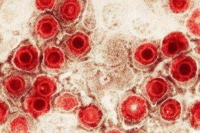 O herpes zoster acontece pela reativação do vírus varicela, que inicialmente causa a catapora -  (crédito: Getty Images)