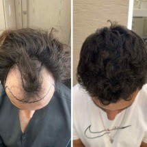 Inovações ajudam a popularizar busca por transplante capilar - DINO