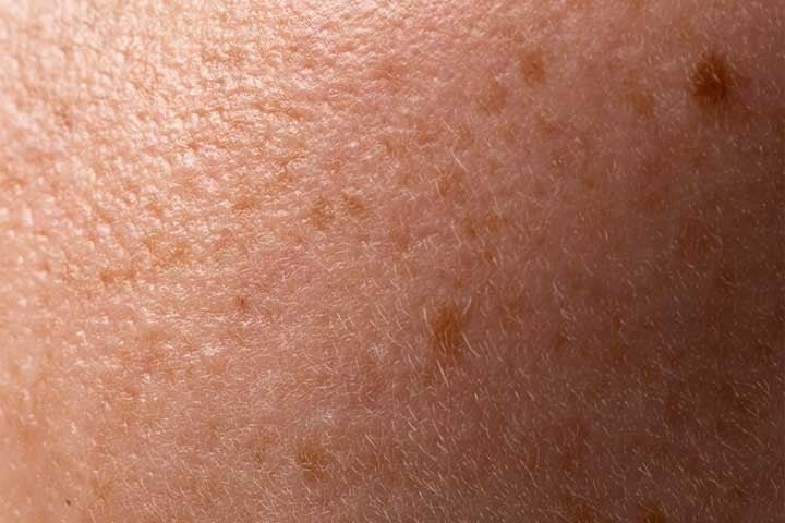 Tratamento de manchas na pele: o bicarbonato de sódio pode ajudar a clarear manchas escuras na pele, como as causadas pela exposição solar ou alterações hormonais. 