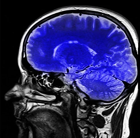 Os lobos frontais e temporais laterais são as áreas cerebrais mais afetadas.A DFT é uma condição mais rara que outros tipos de demência e a hereditariedade é um fator muito influente.