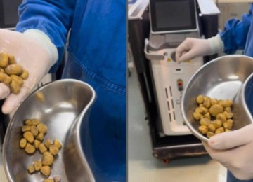 Urologista viraliza ao mostrar pedras na bexiga retiradas de paciente que tomava 3 litros de refrigerante por dia -  (crédito: Reprodução/Redes sociais)