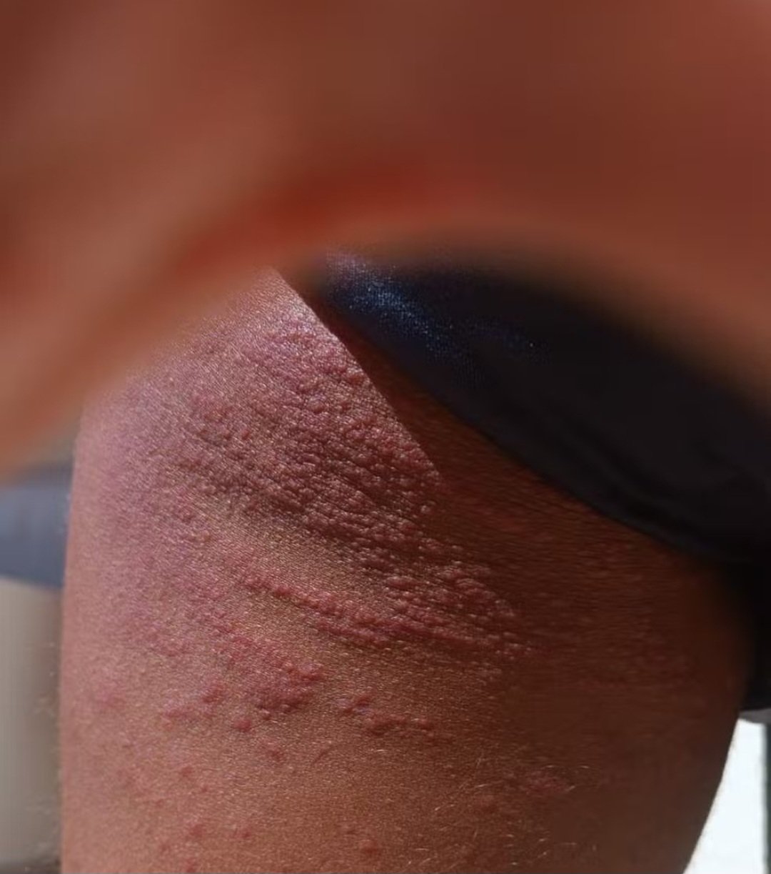 Mas se a pessoa tiver alergia, ela pode ficar com urticária e anafilaxia, que devem ser tratadas com antialérgicos ou corticosteróides prescritos por médicos de forma controlada.
