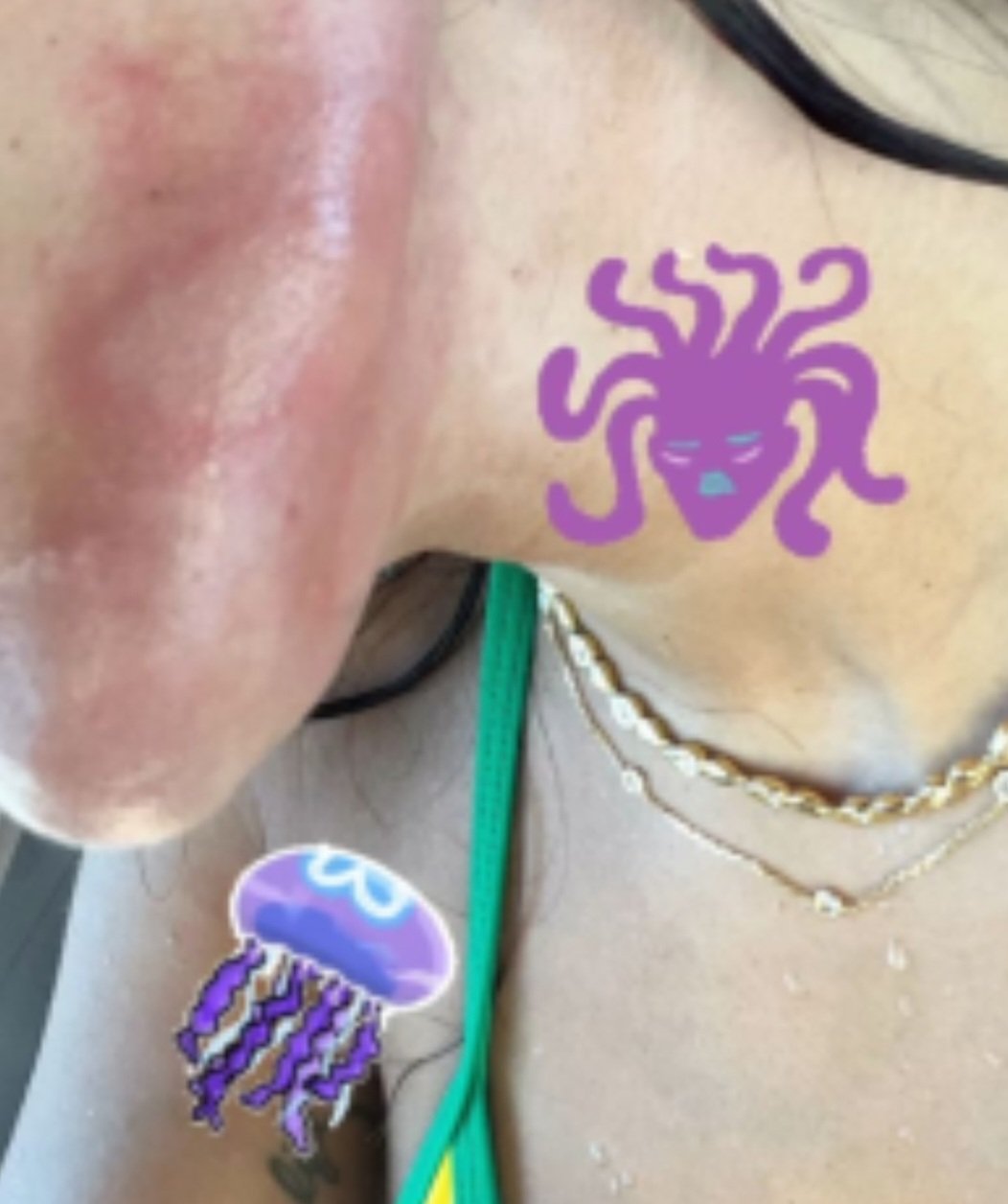 A cantora Anitta divulgou recentemente que foi queimada por uma água-viva durante mergulho numa gruta em Ibiza, ilha da Espanha, no Mar Mediterrâneo.  "Lutei com ela e nunca senti tanta dor. Como se fosse eletrocutada", disse.