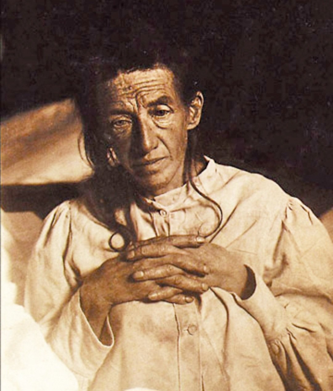 A primeira pessoa diagnosticada com o Mal de Alzheimer foi Auguste Deter, alemã que morreu em 8/4/1906, aos 55 anos. Nascida em Kassel, em 16/5/1850, ela entrou para a história. Adoeceu em 1901, aos 50 anos, e ficou internada o restante da vida. -Domínio público 