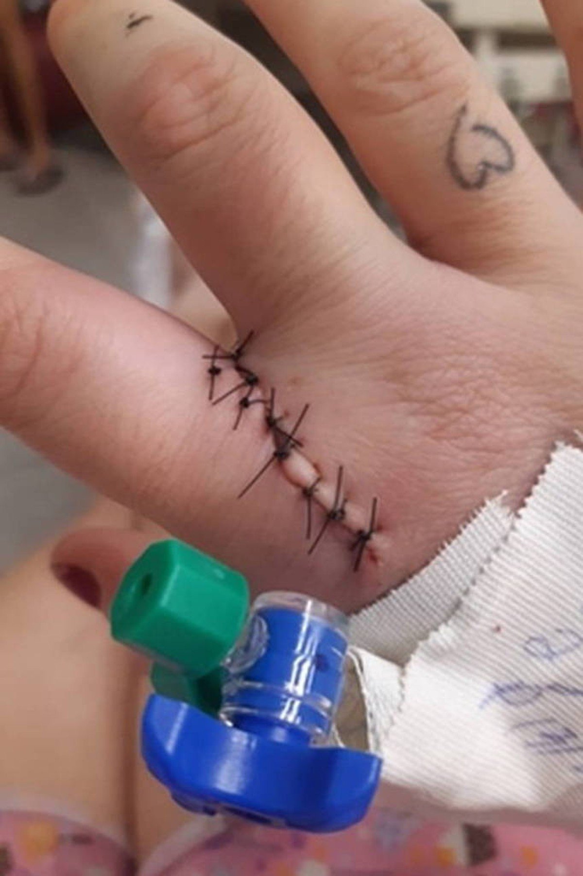 Vítima precisou levar ponto nas mãos após ser arrastada por carro, em Nipoã (SP)