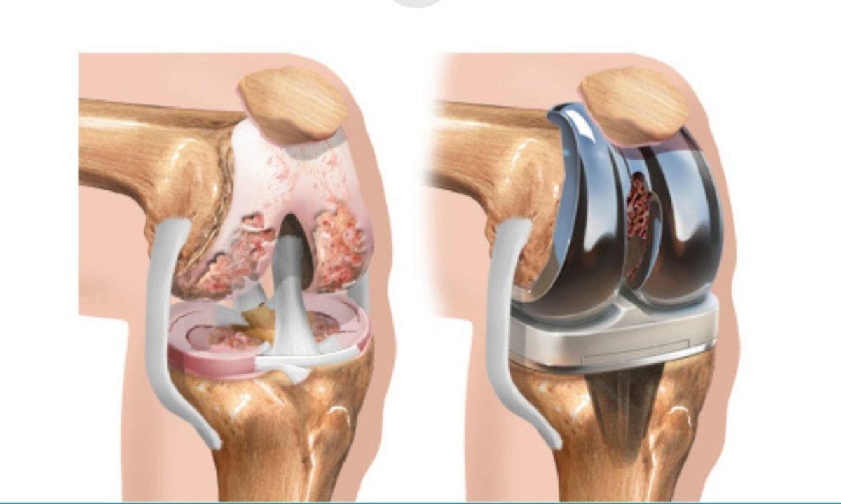 Cirurgia de prótese no joelho vista por dentro -  (crédito: Divulgação/HE)