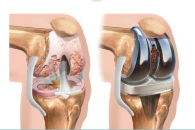 Cirurgia de prótese no joelho vista por dentro -  (crédito: Divulgação/HE)