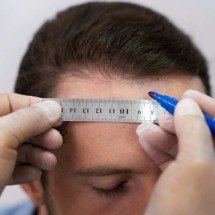 Queda capilar: médico explica quando considerar transplante - DINO