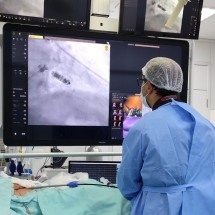 Menor marca-passo do mundo é implantado pela primeira vez em BH